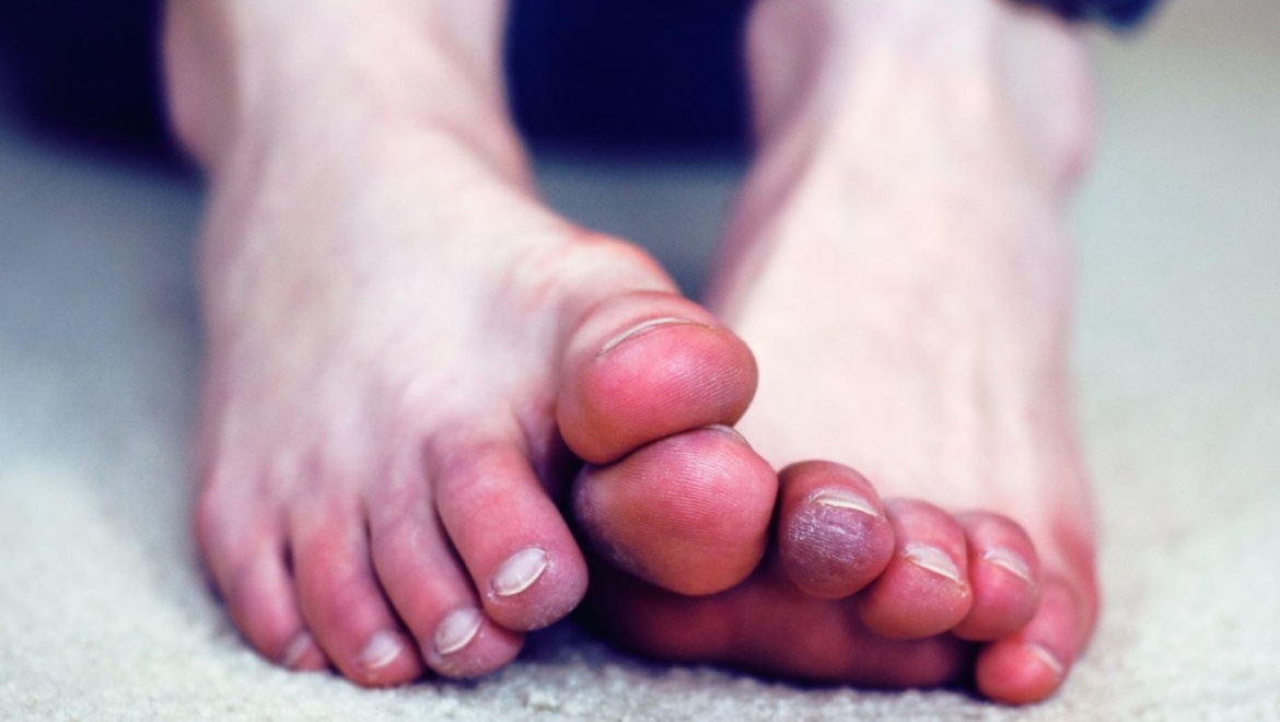 16-летний подросток обморозил ноги