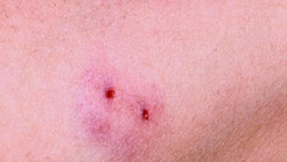 Женщина скончалась от укуса змеи?