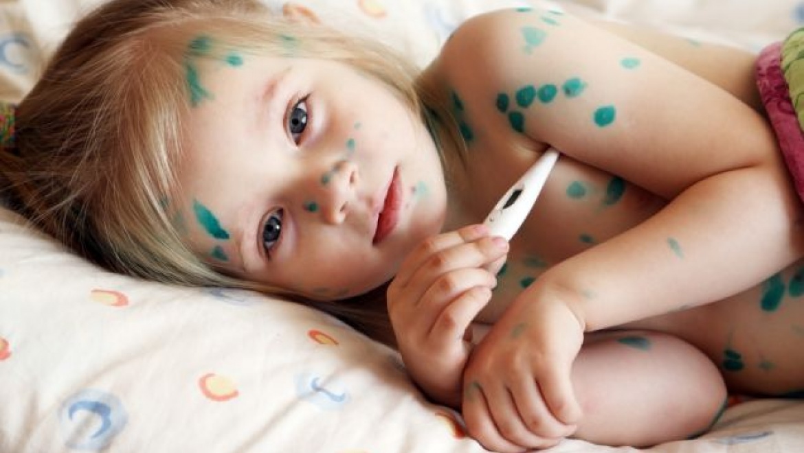 В Казани за 5 месяцев этого года зарегистрировано 6255 случаев ветряной оспы